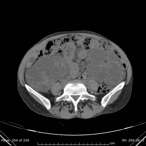 File:Autosomal dominant polycystic kidney disease (Radiopaedia 44122-47684 Axial non-contrast 73).jpg