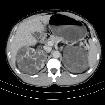 Autosomal dominant polycystic kidney disease (Radiopaedia 66349-75582 B 26).jpg