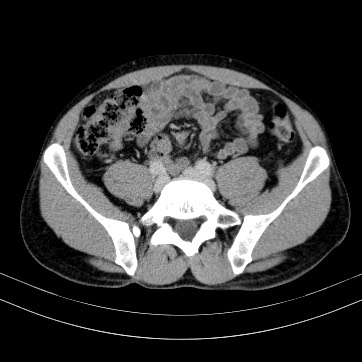 Autosomal dominant polycystic kidney disease (Radiopaedia 66349-75582 B 75).jpg
