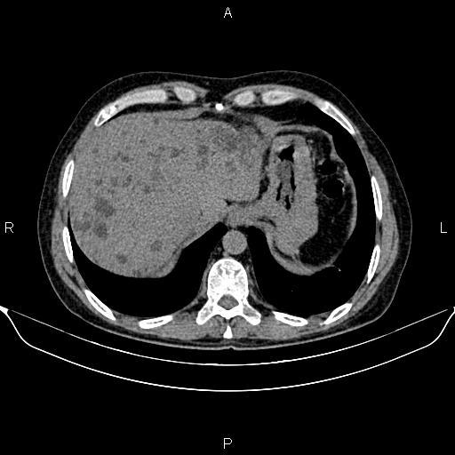 Autosomal dominant polycystic kidney disease (Radiopaedia 87830-104287 Axial non-contrast 10).jpg
