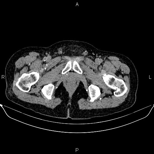Autosomal dominant polycystic kidney disease (Radiopaedia 87830-104287 Axial non-contrast 57).jpg
