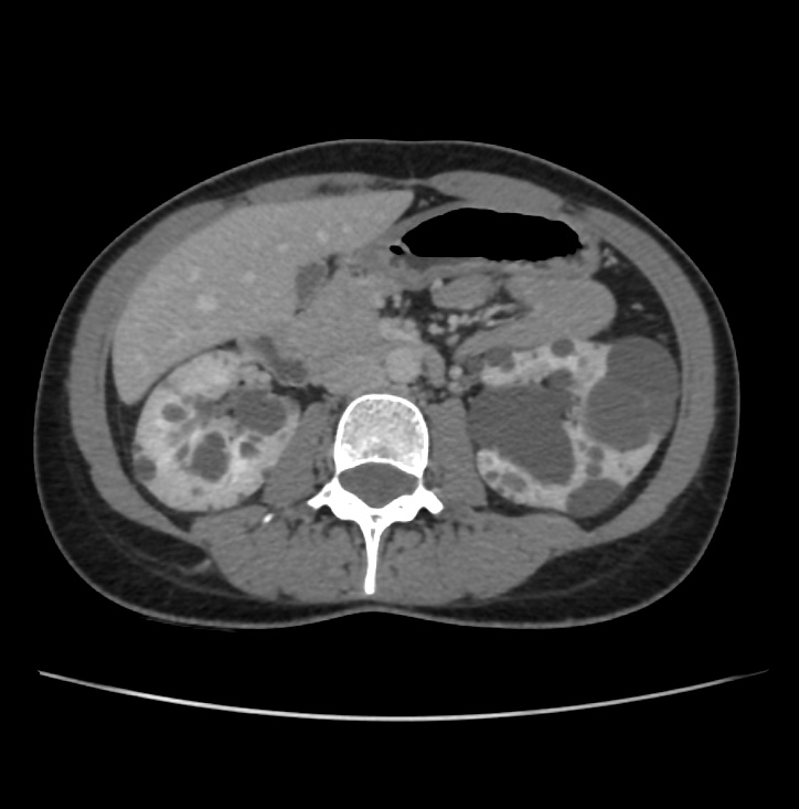 Autosomal dominant polycystic kidney disease - early onset (Radiopaedia 40734-43387 A 35).jpg