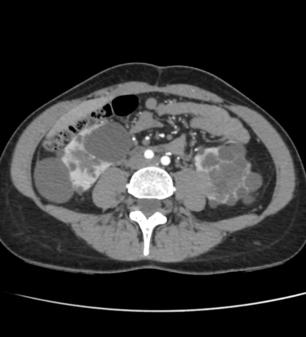 Autosomal dominant polycystic kidney disease - early onset (Radiopaedia 40734-43387 B 44).jpg