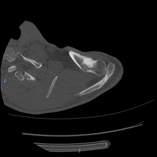 Avascular necrosis after fracture dislocations of the proximal humerus (Radiopaedia 88078-104655 Axial bone window 26).jpg