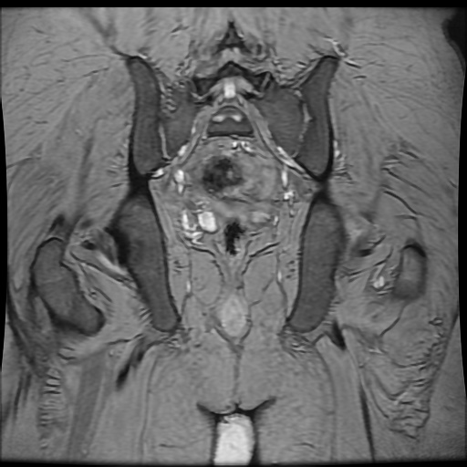 Avascular necrosis of the hip (Radiopaedia 61503-69465 F 75).jpg