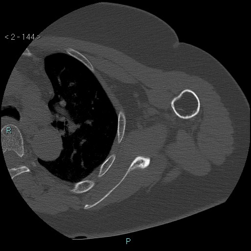 File:Avascular necrosis of the shoulder - Cruess stage I (Radiopaedia 77674-89887 Axial bone window 36).jpg