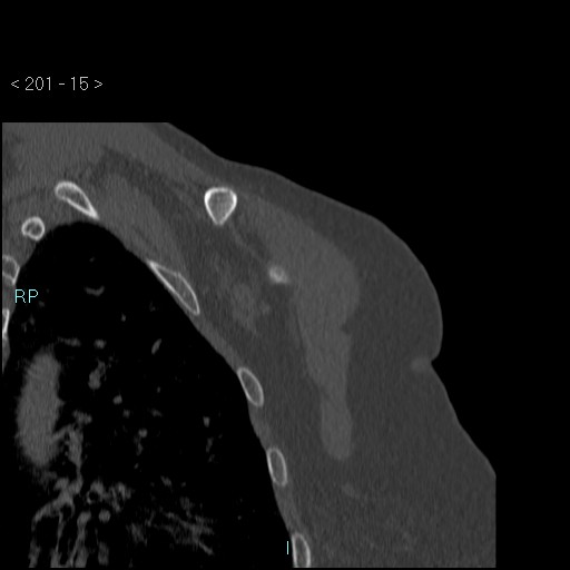 Avascular necrosis of the shoulder - Cruess stage I (Radiopaedia 77674-89887 Coronal bone window 14).jpg