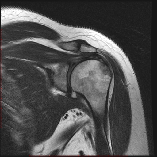 File:Avulsion fracture - greater tuberosity of humerus (Radiopaedia 25457-25703 Coronal T2 7).jpg
