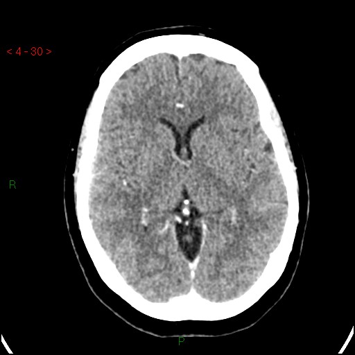 Azygos anterior cerebral artery (Radiopaedia 51987-57833 A 30).jpg