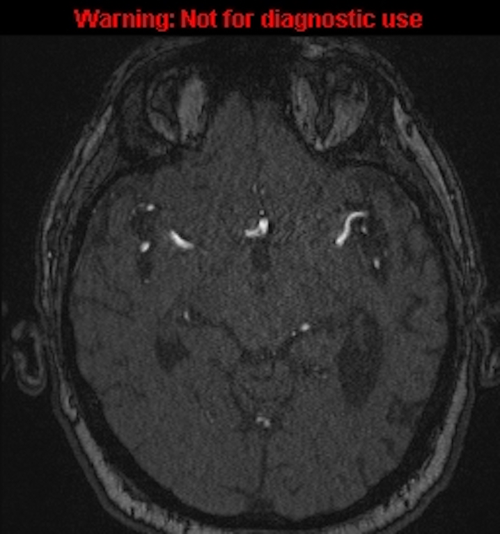 Azygos anterior cerebral artery (Radiopaedia 59325-66677 Axial MRA 73).jpg