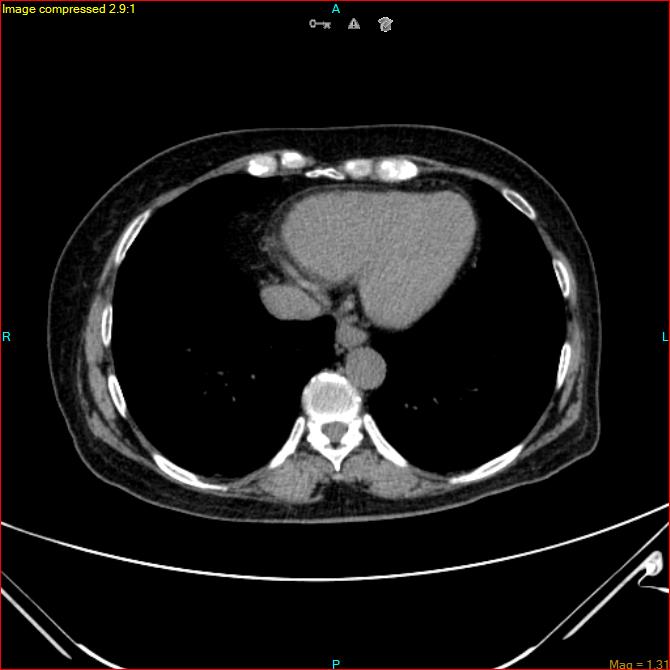 Azygos vein aneurysm (Radiopaedia 77824-90130 A 42).jpg