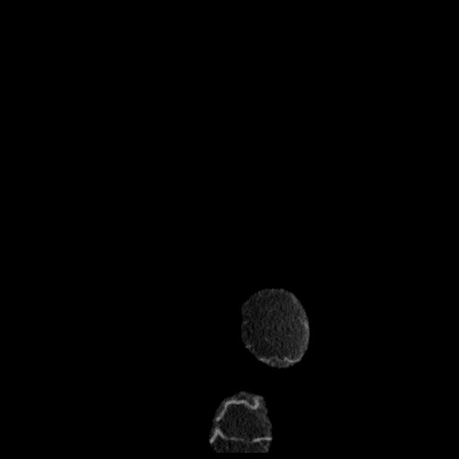 B-cell lymphoma of the mesentery (Radiopaedia 65711-74827 C 5).jpg