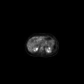 B-cell lymphoma of the mesentery (Radiopaedia 65743-74868 18F-FDG PET-CT 156).jpg