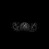 B-cell lymphoma of the mesentery (Radiopaedia 65743-74868 18F-FDG PET-CT 238).jpg