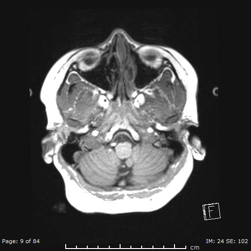 Balo concentric sclerosis (Radiopaedia 61637-69636 Axial T1 9).jpg