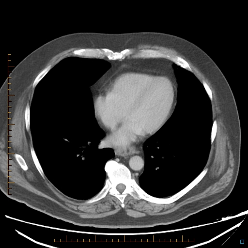 File:Bariatric balloon causing gastric outlet obstruction (Radiopaedia 54449-60672 A 2).jpg