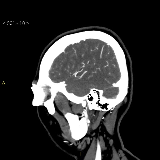 File:Basilar artery thrombosis (Radiopaedia 16260-15944 C 12).jpg