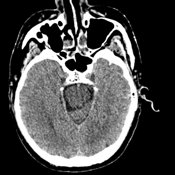 Basilar artery thrombosis (Radiopaedia 53351-59333 Axial non-contrast 49).jpg