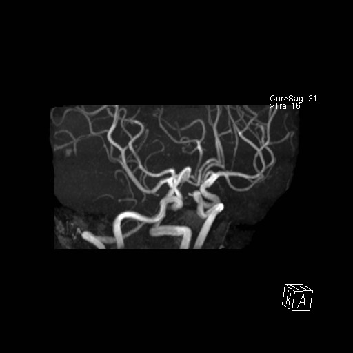 Basilar tip aneurysm (Radiopaedia 26504-26632 D 35).jpg