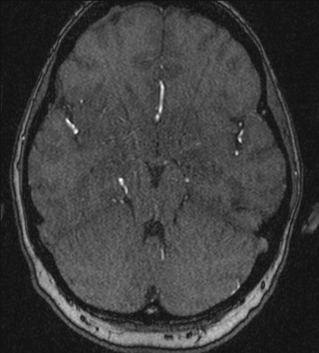 Basilar tip aneurysm (Radiopaedia 26504-26632 MRA 85).jpg