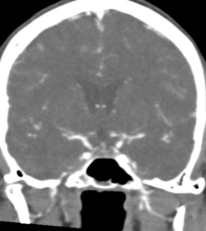 Basilar tip aneurysm with coiling (Radiopaedia 53912-60086 B 65).jpg