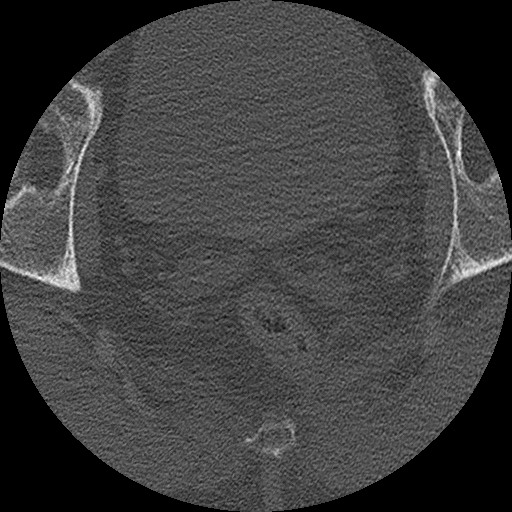 Benign post-traumatic pseudopneumoperitoneum (Radiopaedia 71199-81495 Axial bone window 324).jpg