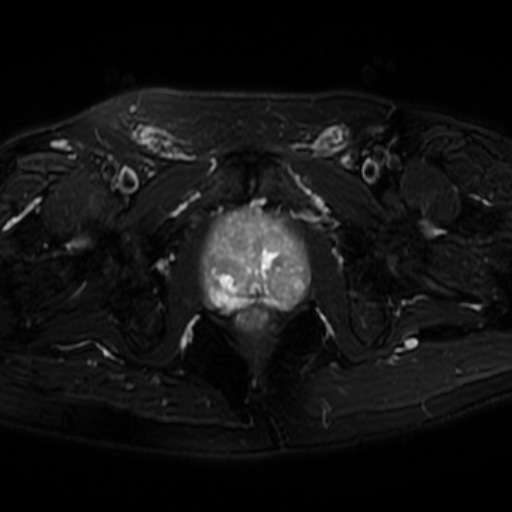 File:Benign prostatic nodular hyperplasia (Radiopaedia 16917-16634 Axial T2 fat sat 12).jpg