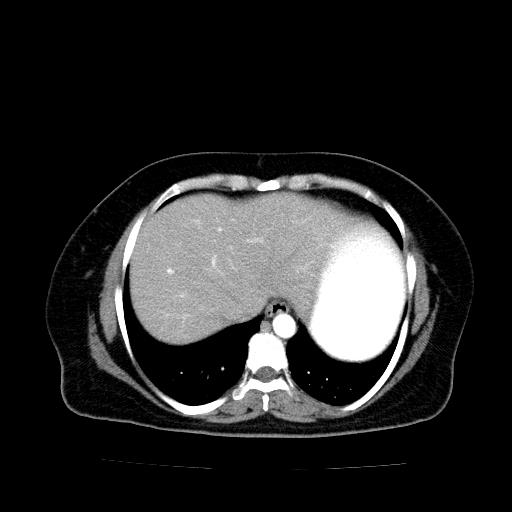 Benign spindle cell tumor - abdominopelvic (Radiopaedia 61300-69212 A 8).jpg