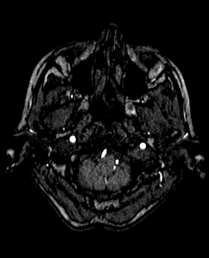 Berry aneurysm of the terminal internal carotid artery (Radiopaedia 88286-104918 Axial TOF 49).jpg