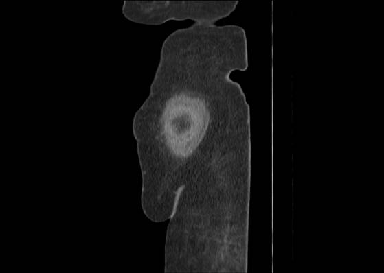 Bicameral celiacomesenteric aneurysm (Radiopaedia 55766-62327 B 3).jpg