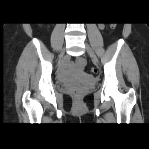 File:Bicornuate uterus (MRI) (Radiopaedia 49206-54296 Coronal 2).jpg
