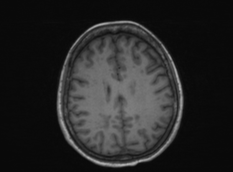 Bilateral PCA territory infarction - different ages (Radiopaedia 46200-51784 Axial T1 194).jpg
