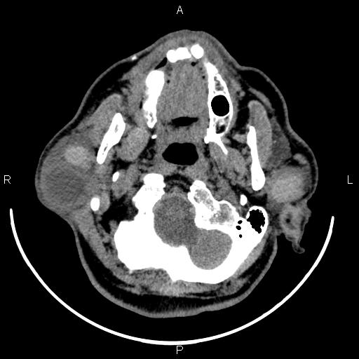 Bilateral Warthin tumors (Radiopaedia 84034-99263 Axial non-contrast 14).jpg