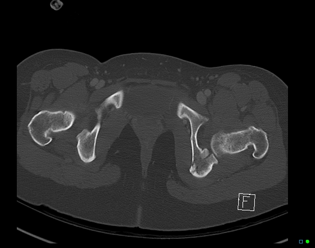 Bilateral acetabular fractures (Radiopaedia 79272-92308 Axial bone window 53).jpg