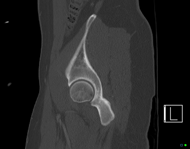 Bilateral acetabular fractures (Radiopaedia 79272-92308 Sagittal bone window 19).jpg