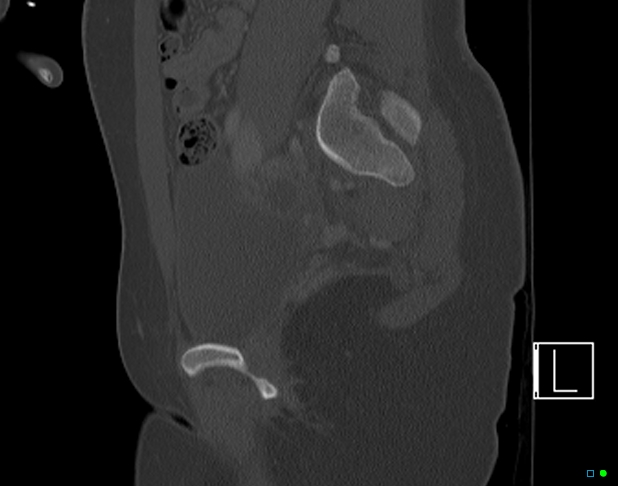 Bilateral acetabular fractures (Radiopaedia 79272-92308 Sagittal bone window 35).jpg
