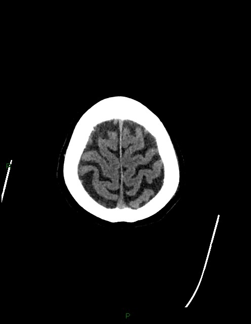Bilateral acute middle cerebral artery territory infarcts (Radiopaedia 77319-89401 Axial non-contrast 82).jpg