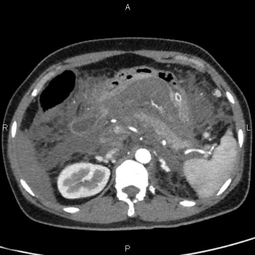 File:Bilateral adrenal gland hyperenhancement in pancreatitis (Radiopaedia 86642-102753 B 40).jpg
