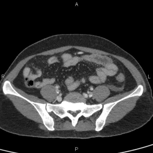 Bilateral adrenal gland hyperenhancement in pancreatitis (Radiopaedia 86642-102753 E 83).jpg