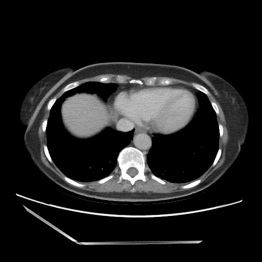 Bilateral adrenal granulocytic sarcomas (chloromas) (Radiopaedia 78375-91007 A 13).jpg