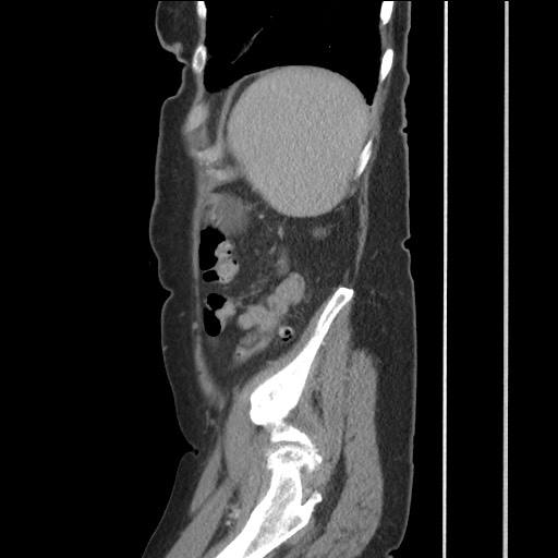 Bilateral adrenal granulocytic sarcomas (chloromas) (Radiopaedia 78375-91007 C 112).jpg