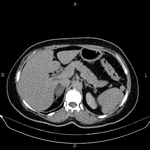 Bilateral benign adrenal adenomas (Radiopaedia 86912-103124 Axial C+ delayed 31).jpg