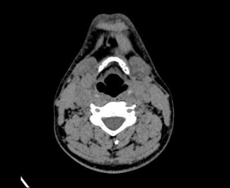 Bilateral carotid body tumors (Radiopaedia 61841-69870 Axial non-contrast 57).jpg