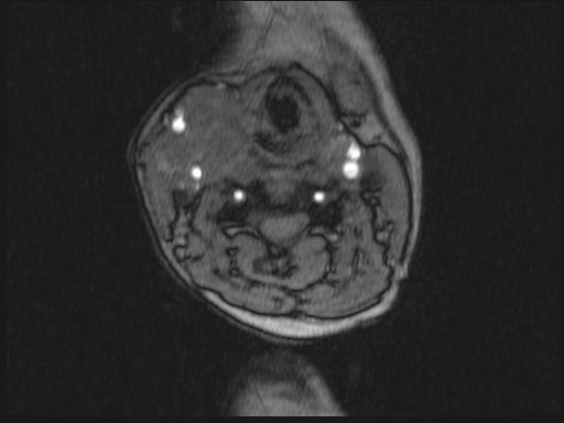 Bilateral carotid body tumors and right glomus jugulare tumor (Radiopaedia 20024-20060 Axial MRA 248).jpg