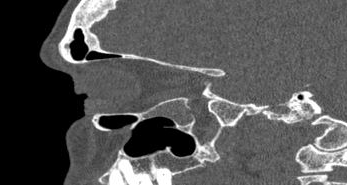File:Bilateral ectopic infraorbital nerves (Radiopaedia 49006-54084 Sagittal 19).png