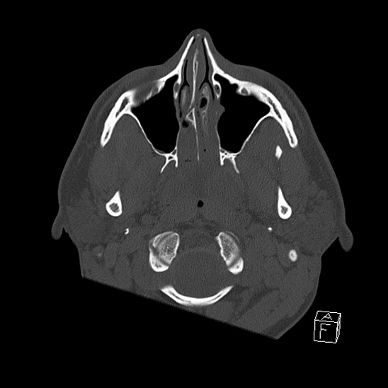 Bilateral occipital condyle fracture (type 2) (Radiopaedia 87675-104089 Axial bone window 5).jpg