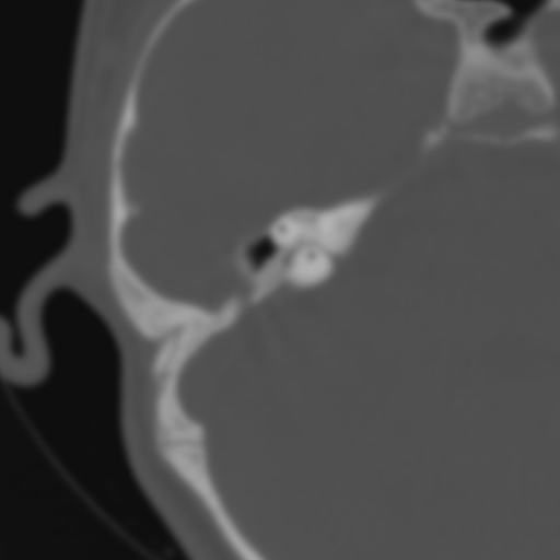 Bilateral otosclerosis (Radiopaedia 57237-64157 B 77).jpg