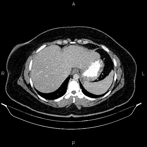 Bilateral ovarian dermoid cysts (Radiopaedia 85785-101603 A 18).jpg