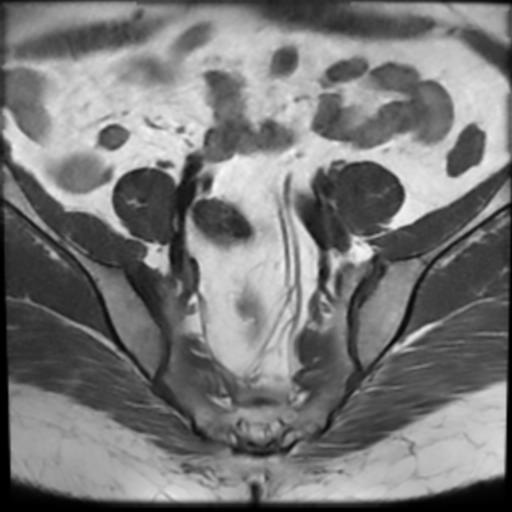 File:Bilateral ovarian dermoid cysts (Radiopaedia 90152-107338 Axial T1 5).jpg