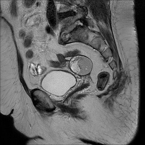 File:Bilateral ovarian dermoid cysts (Radiopaedia 90152-107338 Sagittal T2 10).jpg